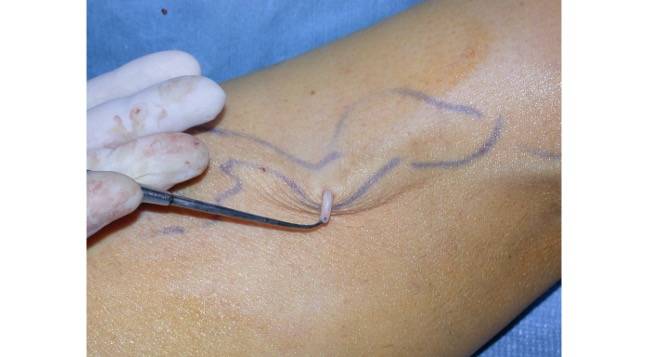 Phlebectomie au bloc opératoire