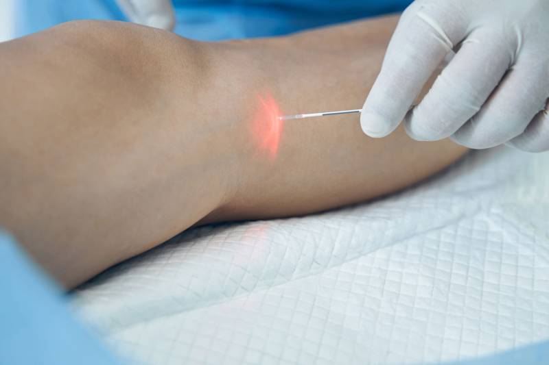 Laser endoveineux : Fibre Laser